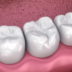 Fissure dental fillings, Medically accurate 3D illustration Fissure dental fillings, Medically accurate 3D illustration