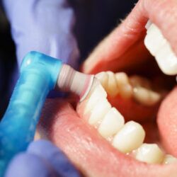 Dental Cleaning Close-up Dental Cleaning Close-up