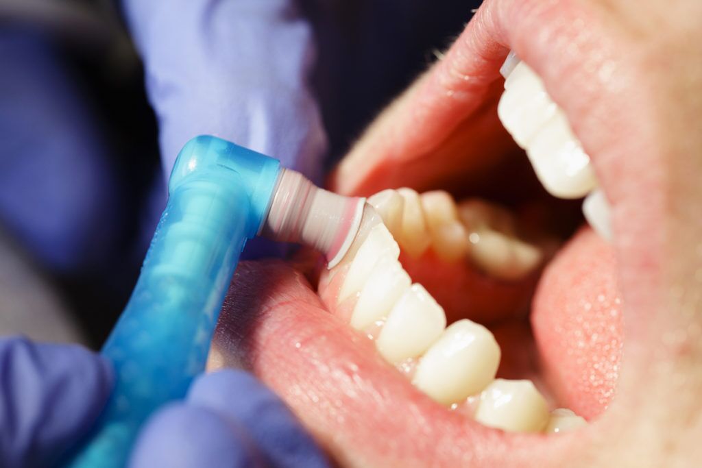 Dental Cleaning Close-up